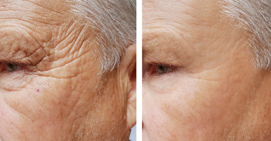 filler viso risultati prima e dopo