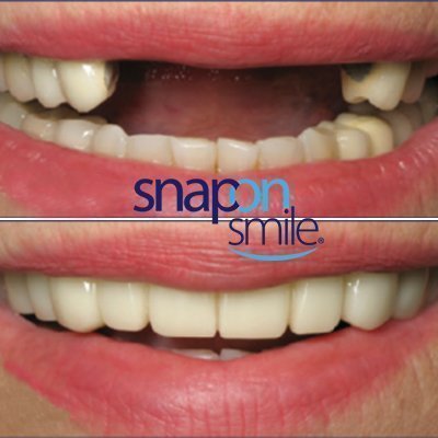 snap-on-smile-img1-1-1.jpg