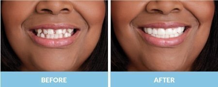 snap-on-smile4-1.jpg